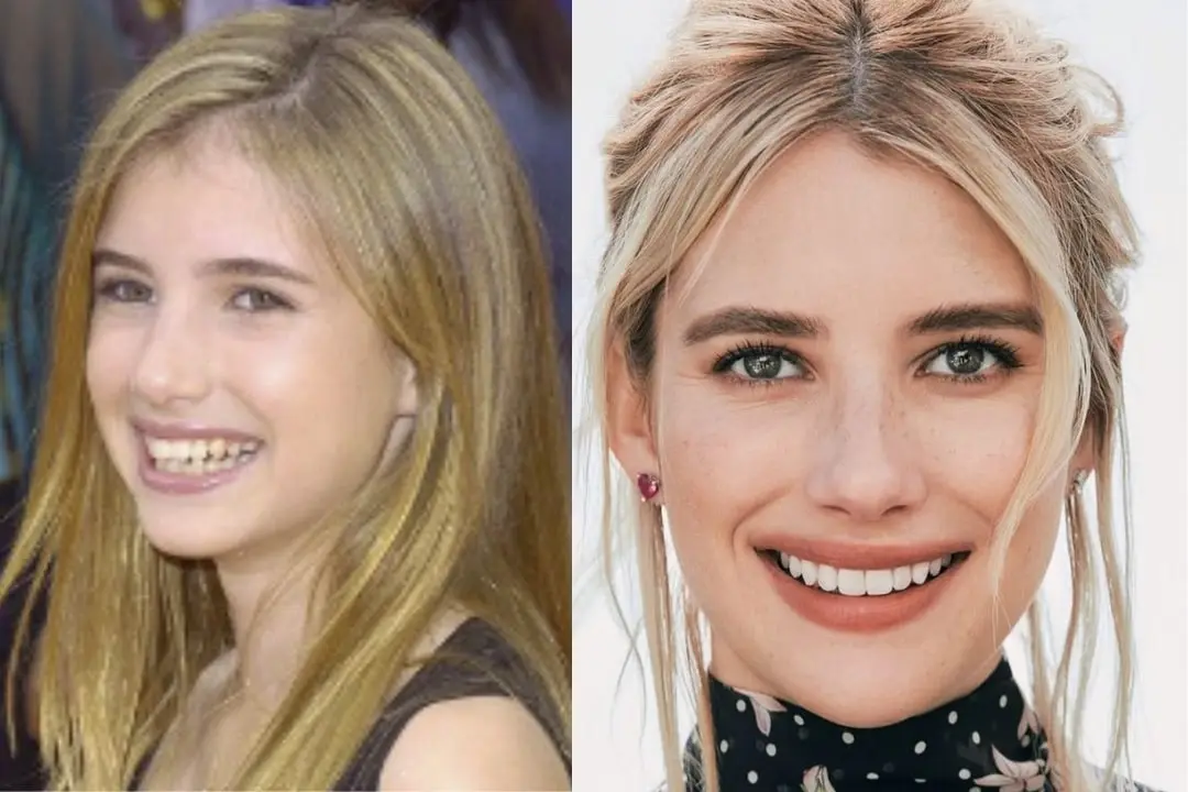 Emma Roberts teeth veneers before and after Emma Roberts teeth veneers Antalya, Turkey