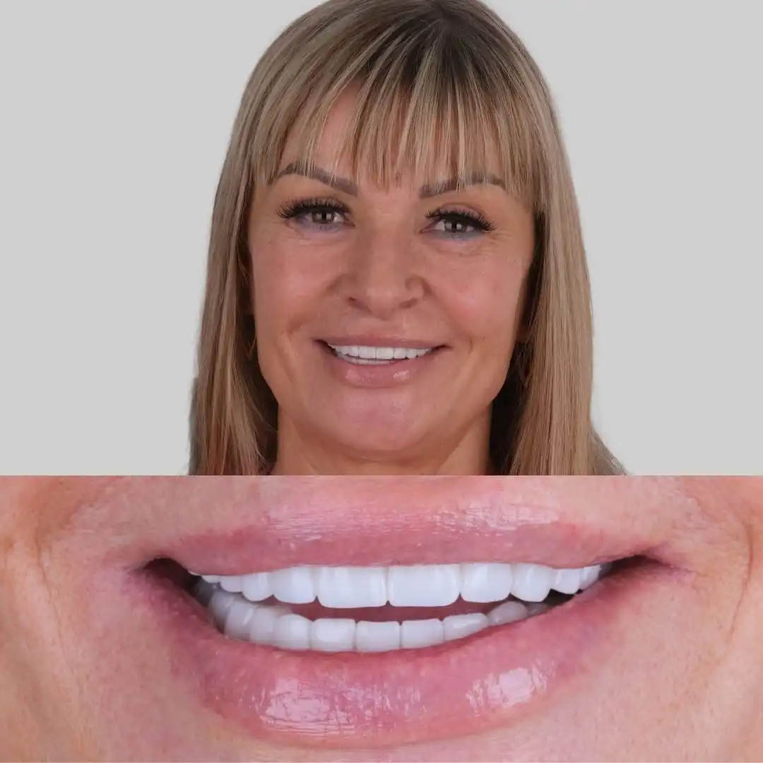 What are the main types of dental implants?