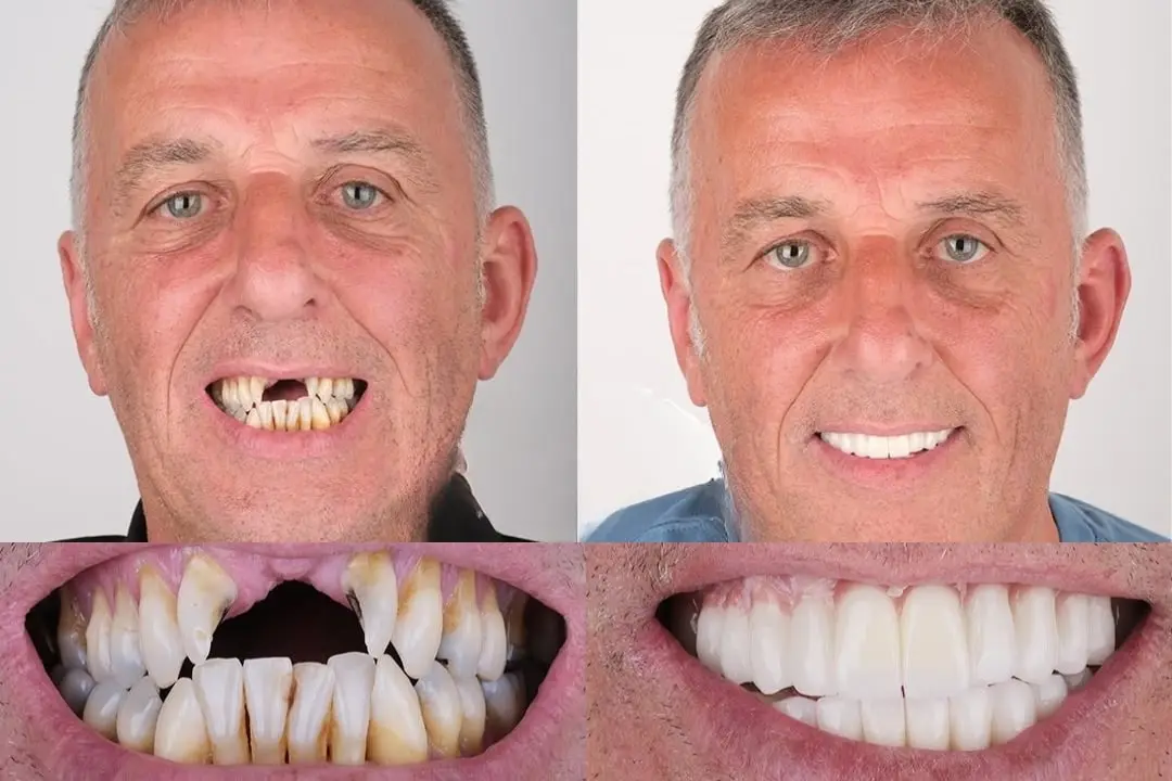 Front tooth dental implant before and after Front tooth dental implant before and after
