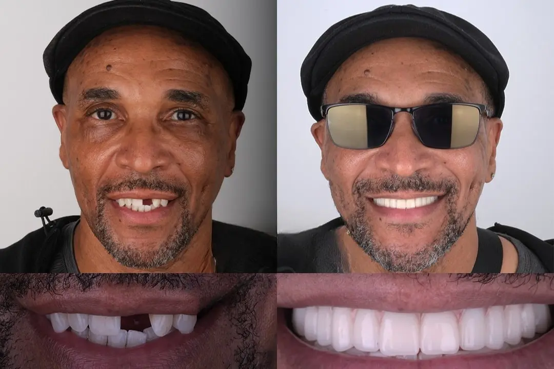 Front tooth implant before and after Front tooth implant before and after