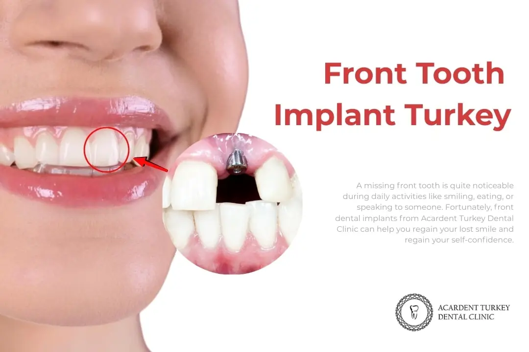 Front tooth dental implants Front tooth dental implants