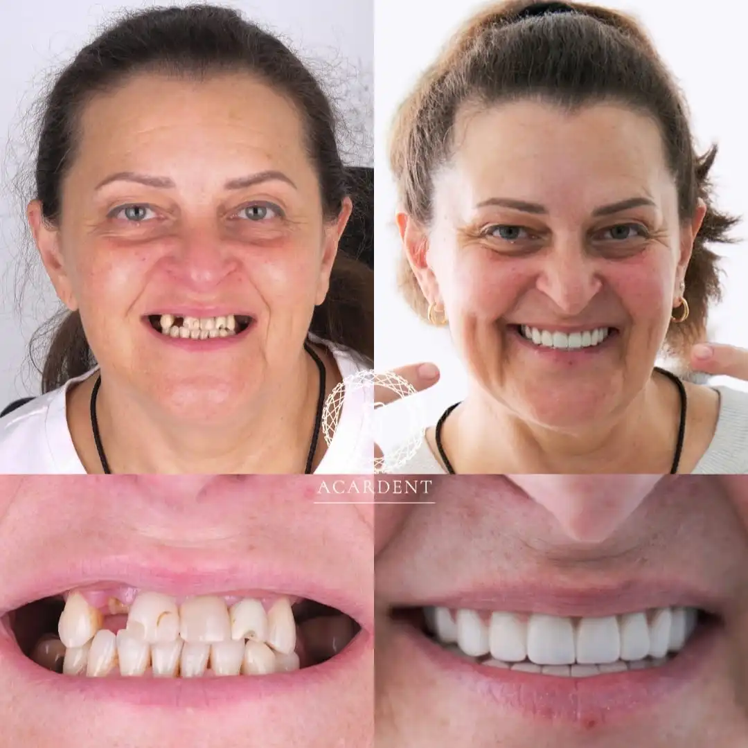 All-on-6 dental implants in Turkey