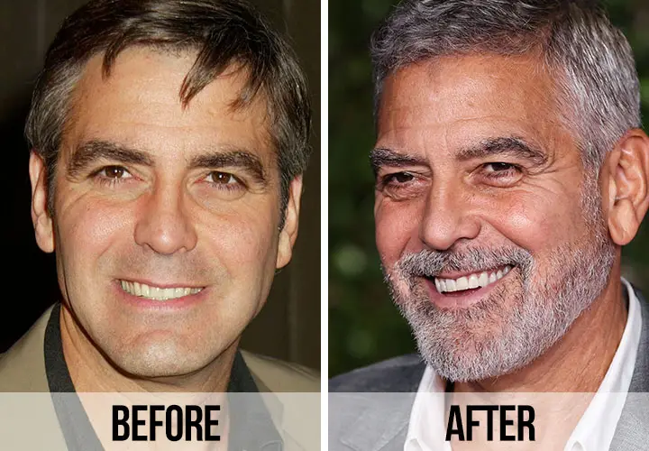 Celebrity veneers before and after Antalya, Turkey
