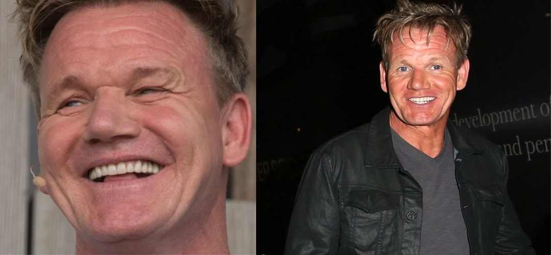 Gordon Ramsay celebrity veneers before and after Antalya, Turkey