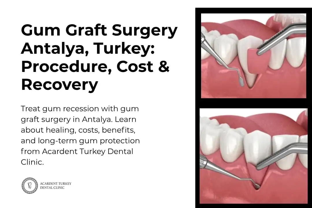 Dental Implants Side Effects