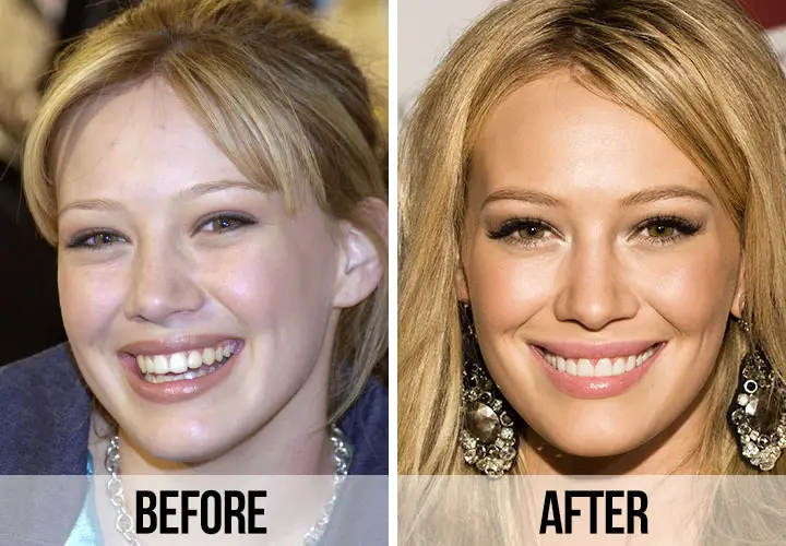 Celebrity veneers before and after Antalya, Turkey