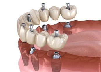 How is All on 6 Treatment Performed?