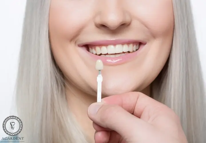 How long do veneers in Turkey last? Antalya