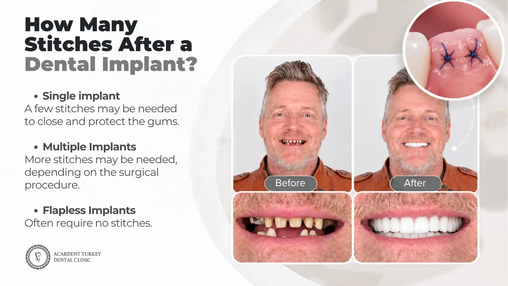 How many stitches are needed after a dental implantin Antalya, Turkey