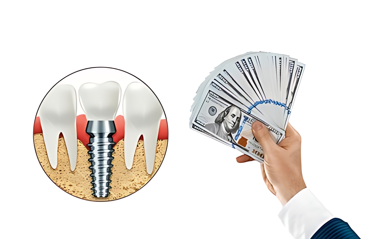 How much do dental implants cost Turkey?