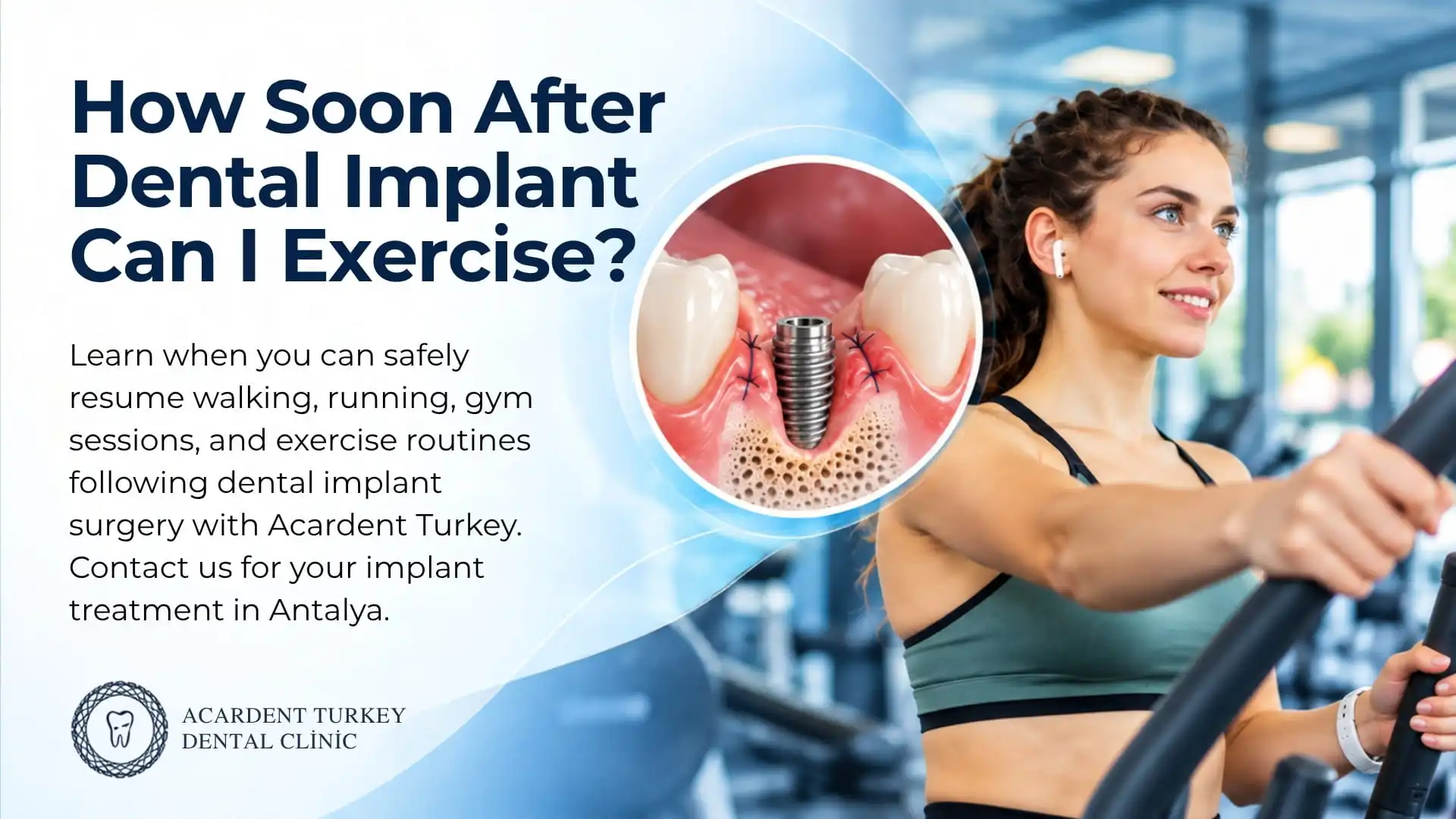 How Soon After Dental Implant Surgery Can I Exercise?