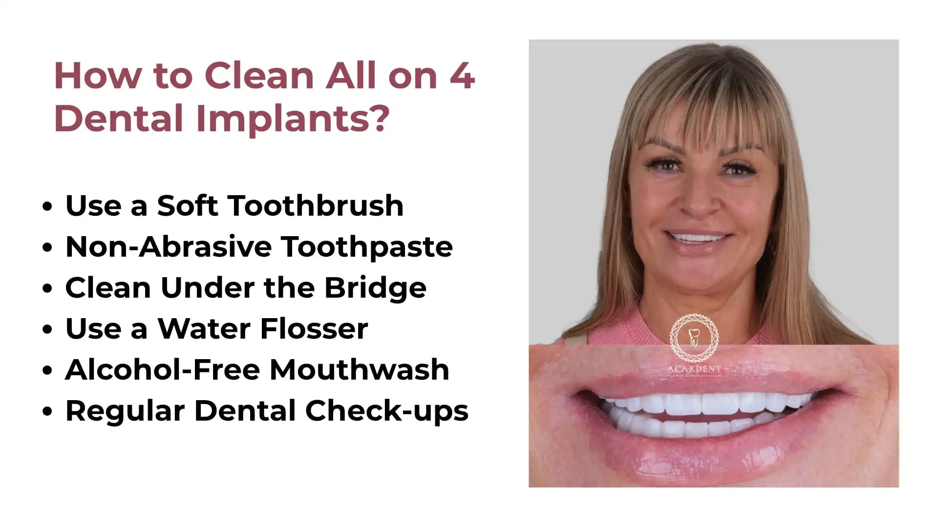 How to Clean All on 4 Dental Implants? 