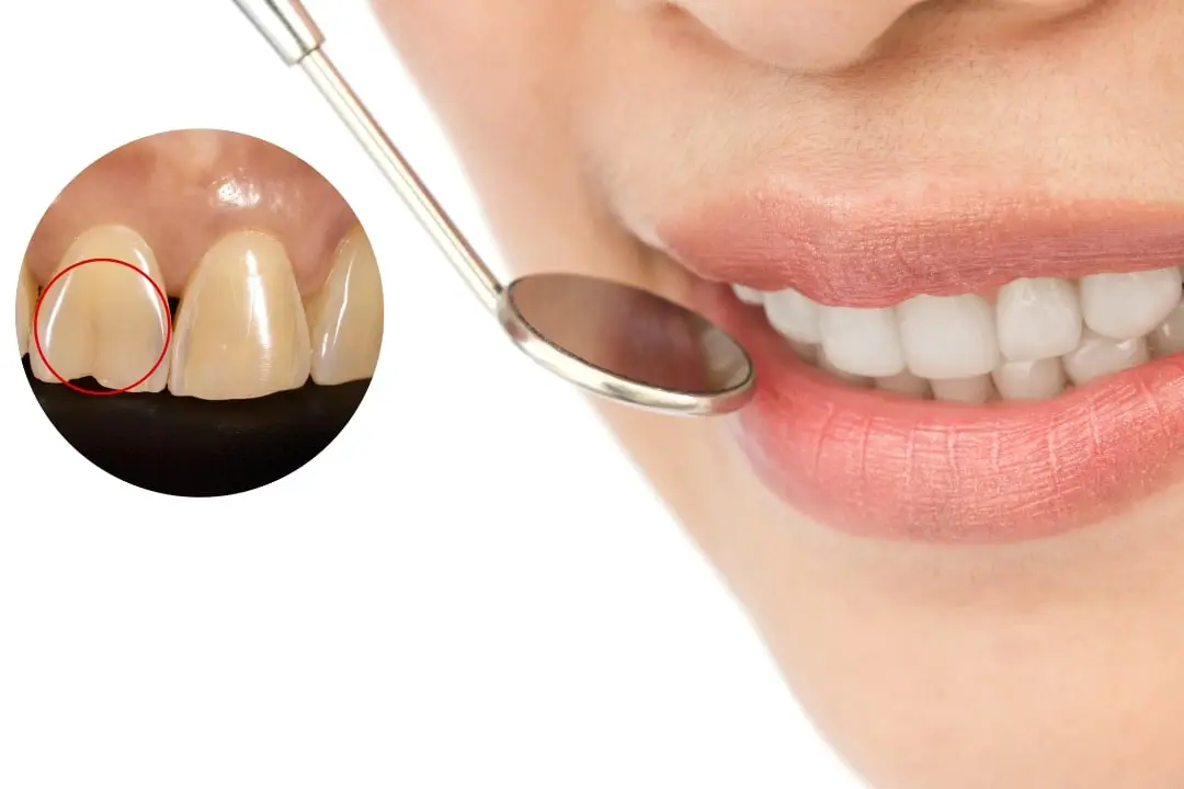 How to fix a cracked tooth naturally? How to fix a cracked tooth naturally?
