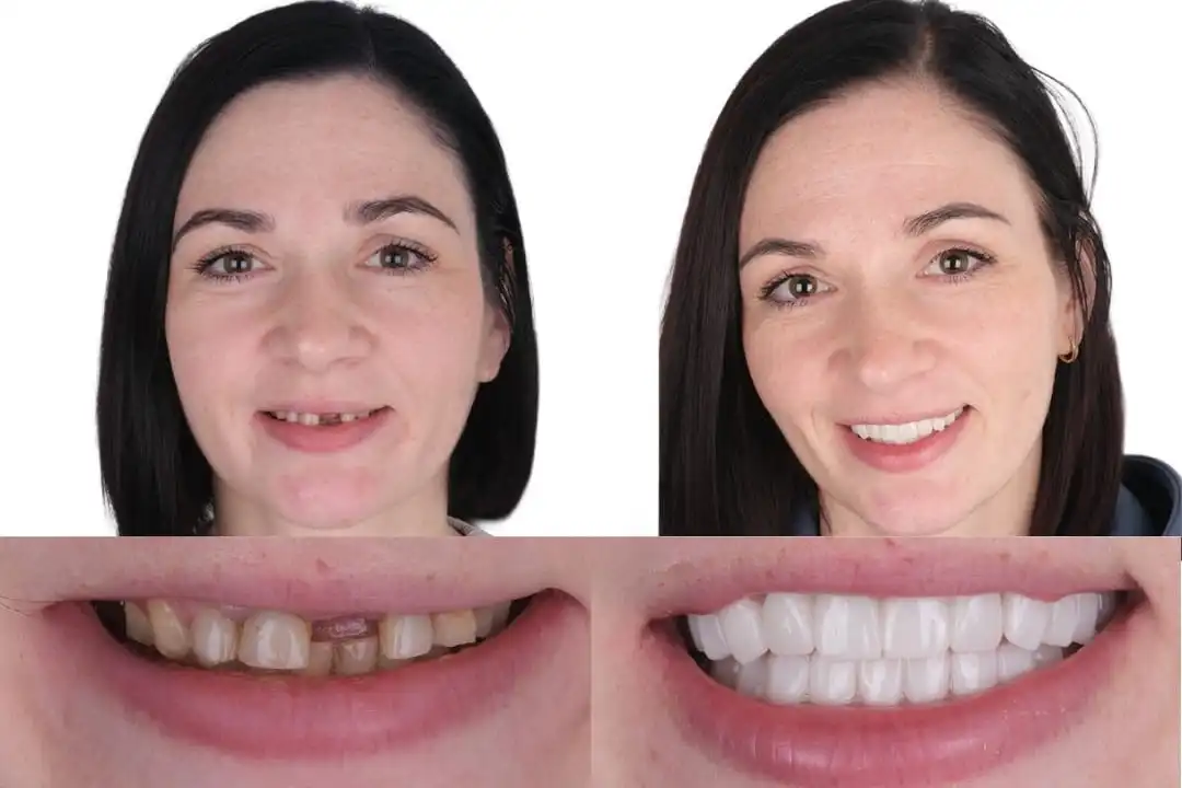 How to heal faster after dental implants?