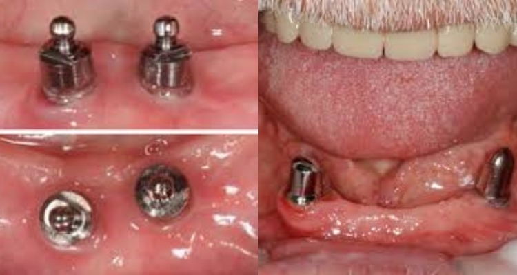 Implant-supported overdenture prostheses Antalya, Turkey