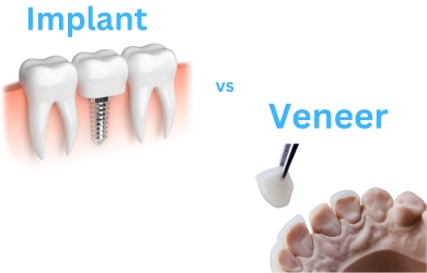 implants-vs-veneer-antalya-turkey