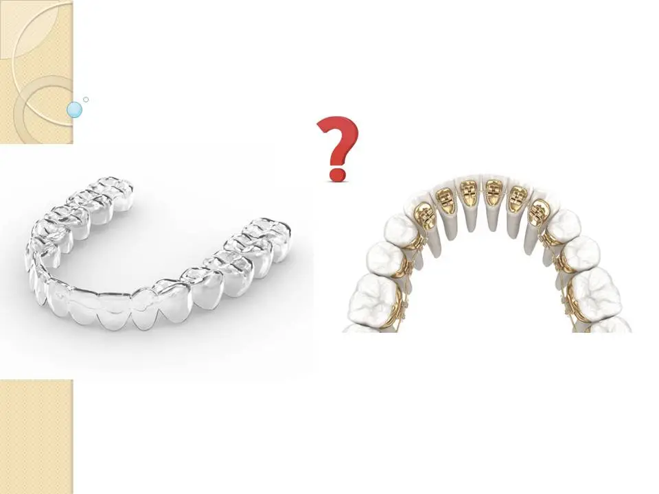 Invisalign vs lingual braces Antalya Turkey