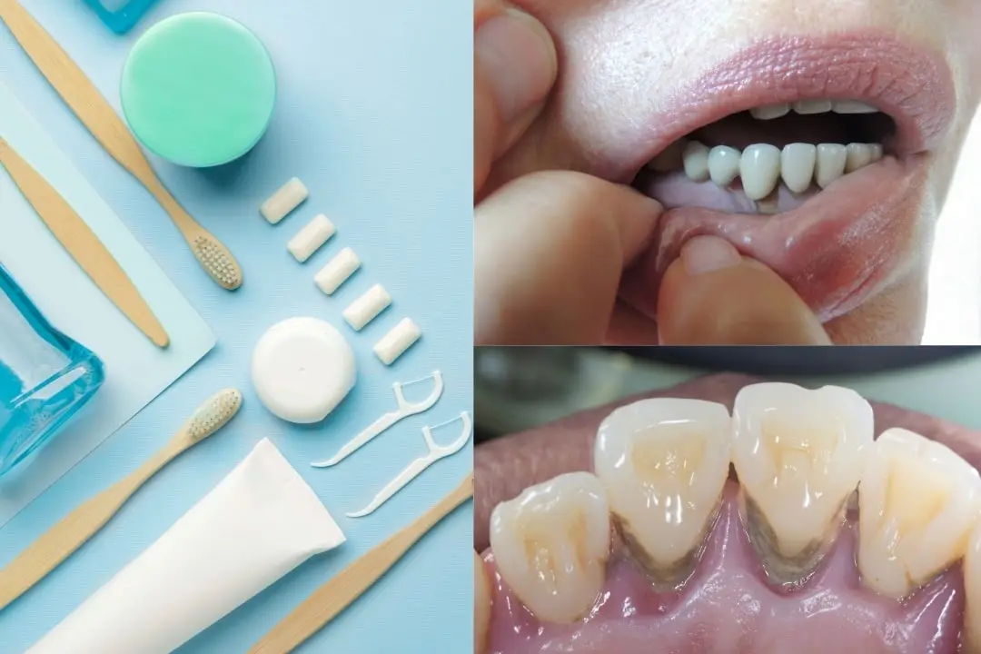 Is periodontal disease contagious?
