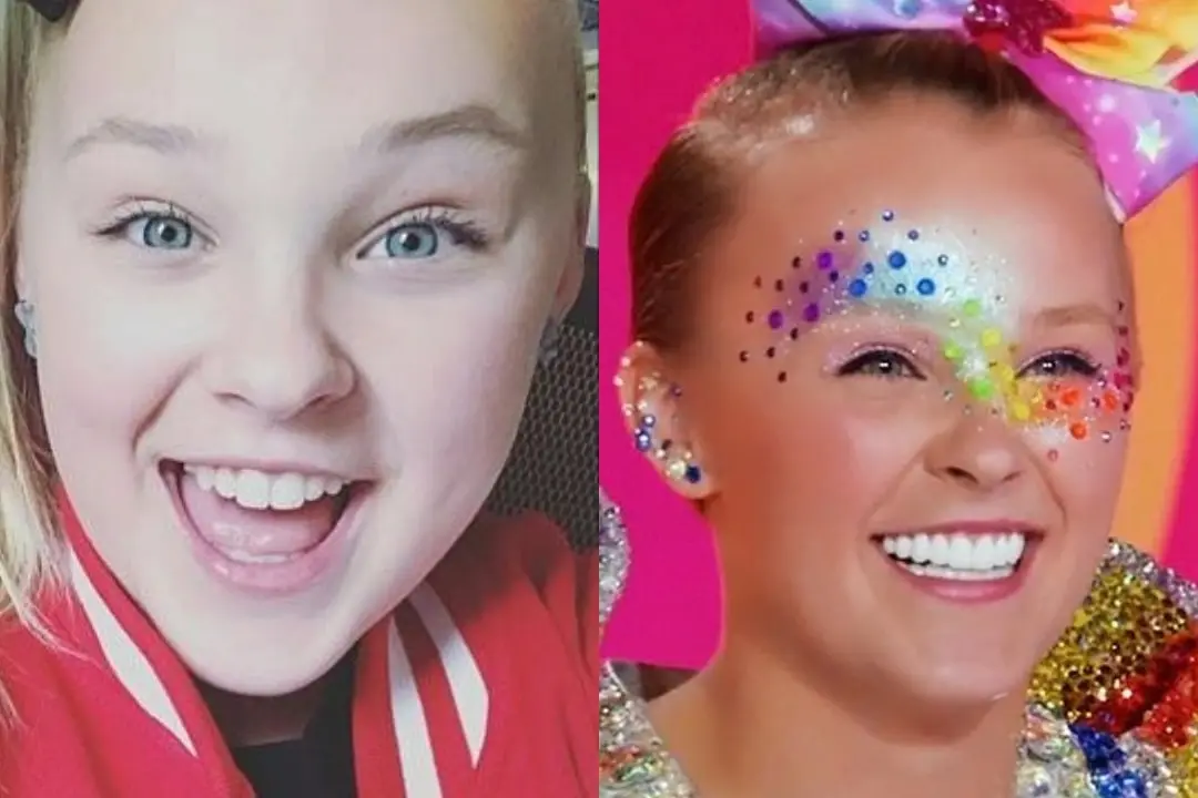 JoJo Siwa teeth veneer before and after Antalya, Turkey