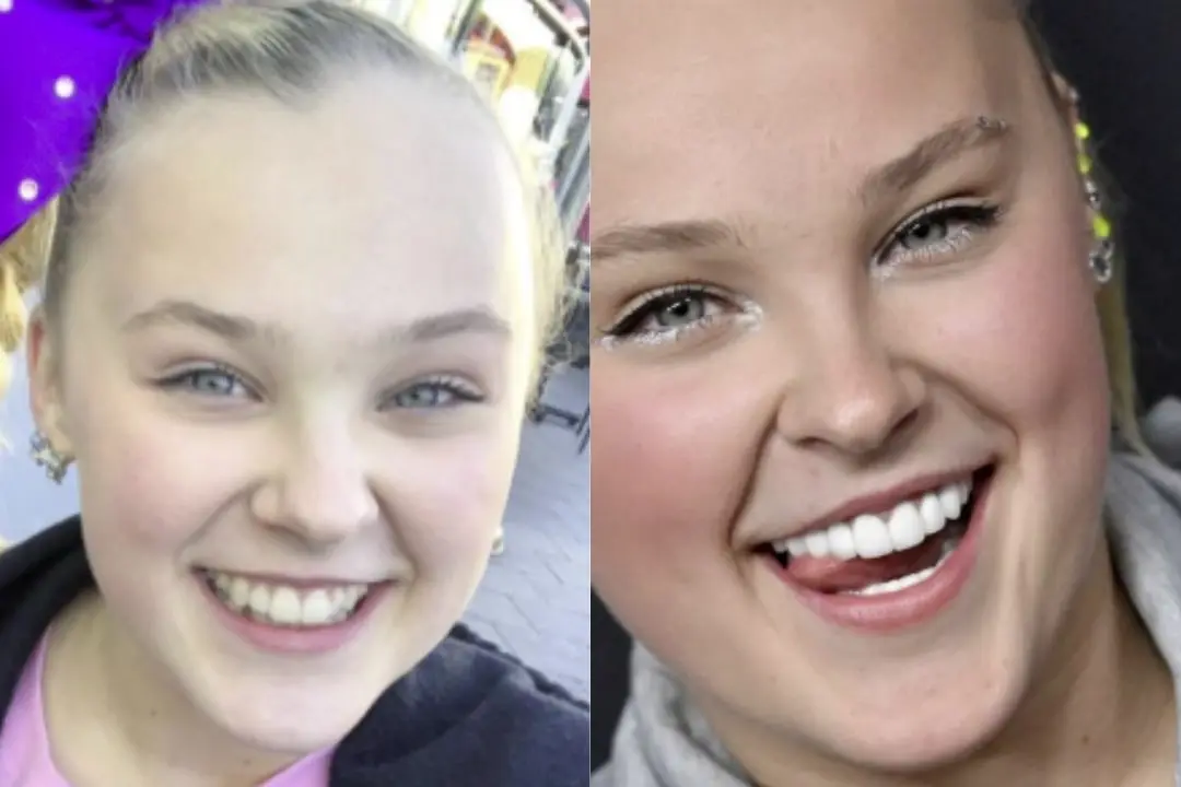JoJo Siwa teeth before and after Antalya, Turkey