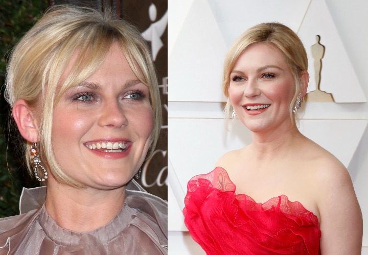 Kirsten Dunst celebrity veneers before and after Antalya, Turkey