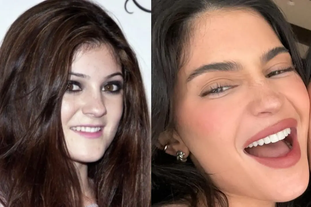 Kylie Jenner teeth veneers before and after Kylie Jenner Celebrity veneers before and after Antalya, Turkey
