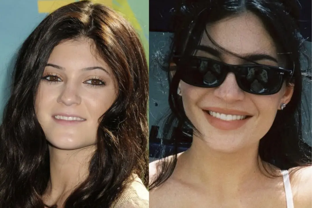 Kylie Jenner celebrity veneers before and after Kylie Jenner Celebrity veneers before and after Antalya, Turkey