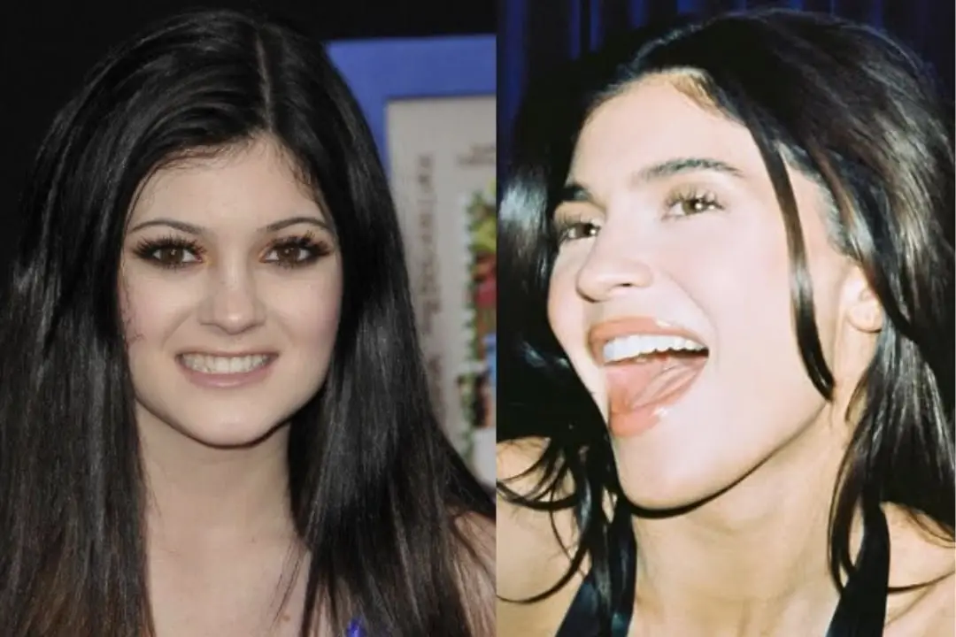 Kylie Jenner celebrity veneers before and after Kylie Jenner Celebrity veneers before and after Antalya, Turkey
