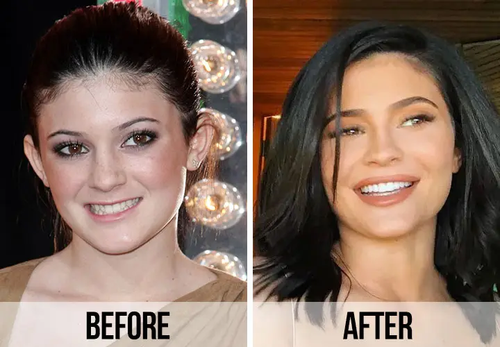 Kylie Jenner teeth before and after Antalya, Turkey