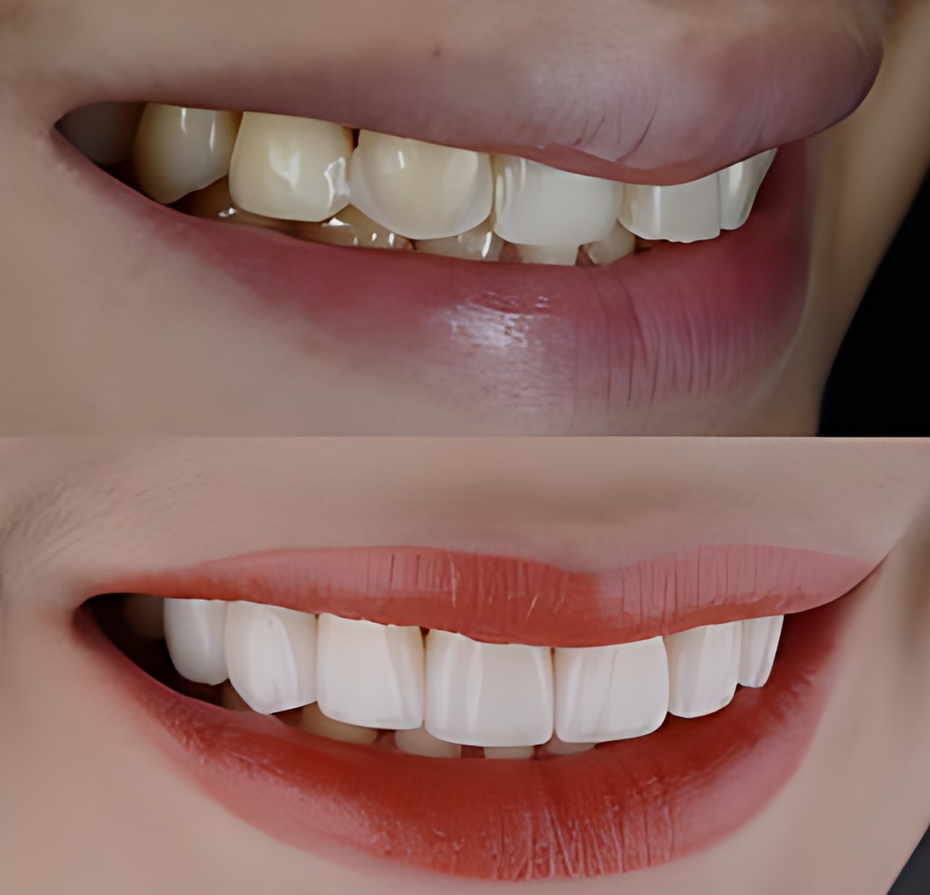 laminate-veneers-before-after-turkey-antalya