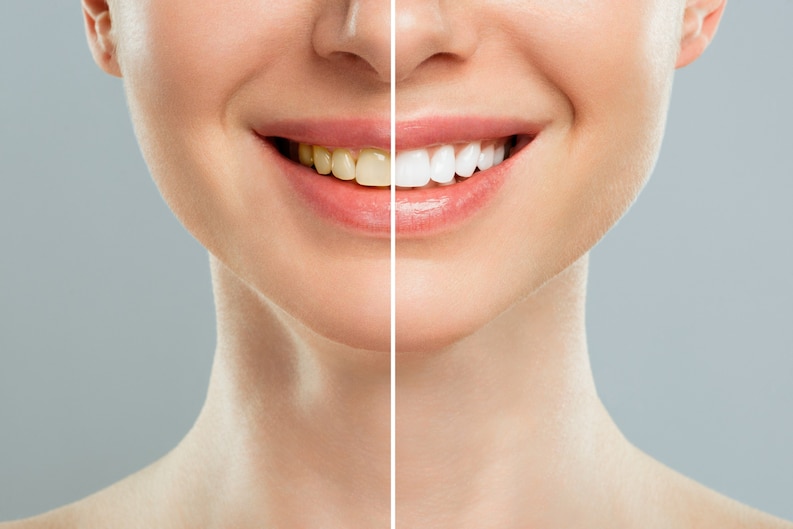 laminate-veneers-woman-teeth-before-after-whitening