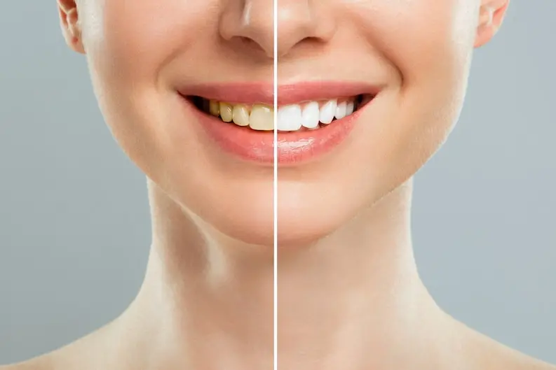 laminate-veneers-woman-teeth-before-after-whitening