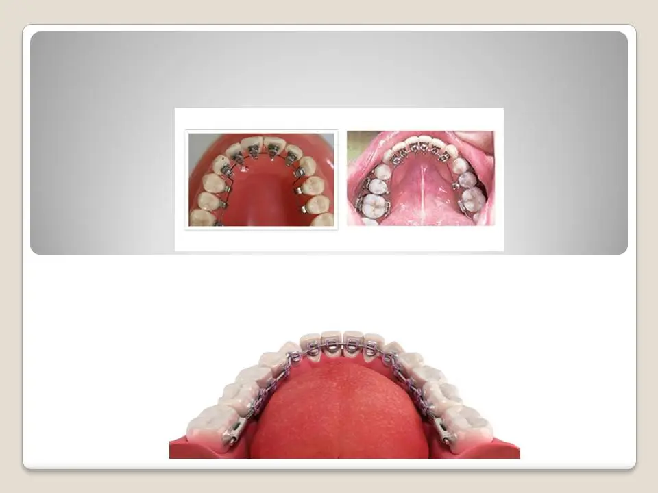 Bottom lingual braces Antalya Turkey