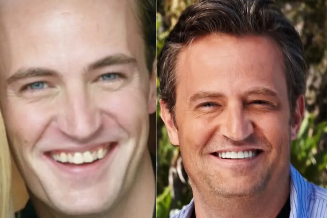 Matthew Perry teeth veneer before and after Antalya, Turkey