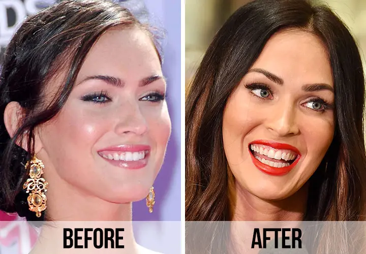 Celebrity veneers before and after Antalya, Turkey