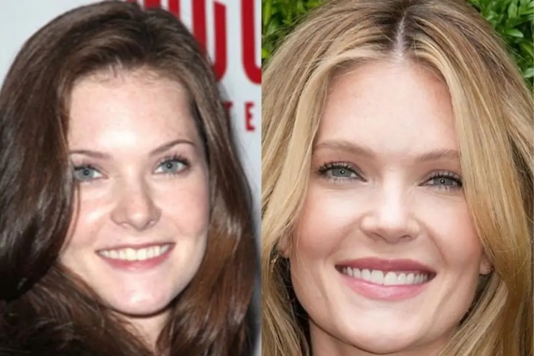 Meghann Fahy teeth veneers Antalya, Turkey