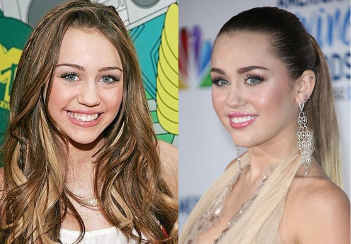 Miley Cyrus celebrity veneers before and after Antalya, Turkey