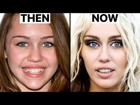 Miley Cyrus Teeth Before After Turkey