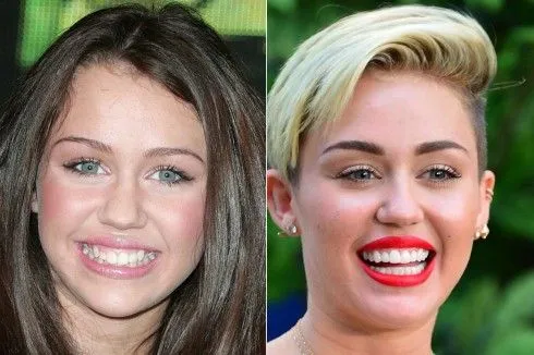 Miley Cyrus Teeth Before After Turkey