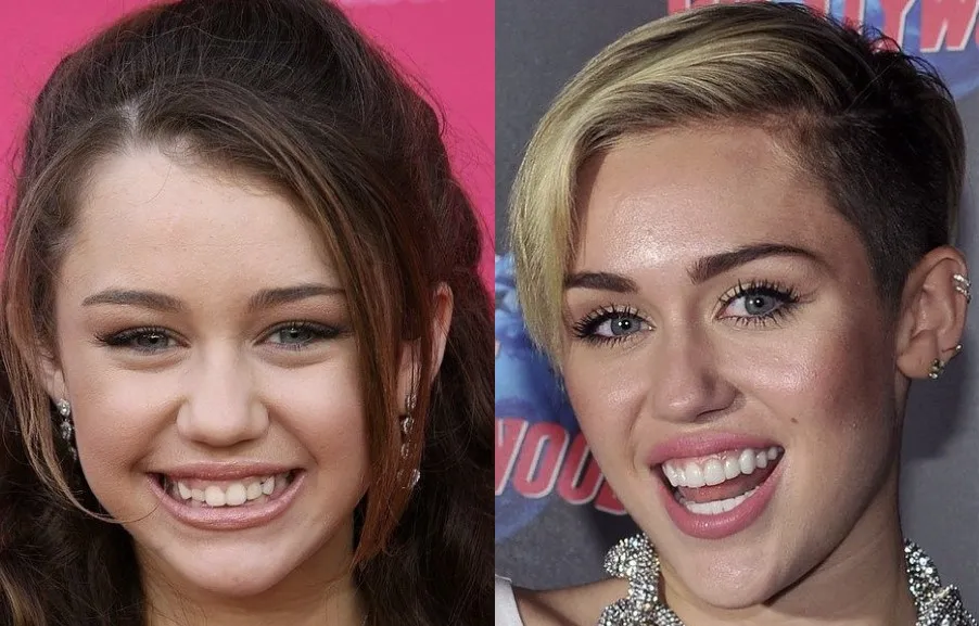 Miley Cyrus Teeth Before After Turkey