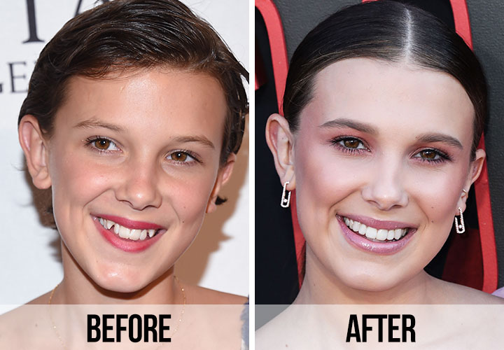 Millie Bobby Brown Celebrity veneers before and after Antalya, Turkey