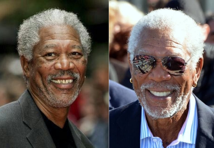 Morgan Freeman celebrity veneers before and after Antalya, Turkey