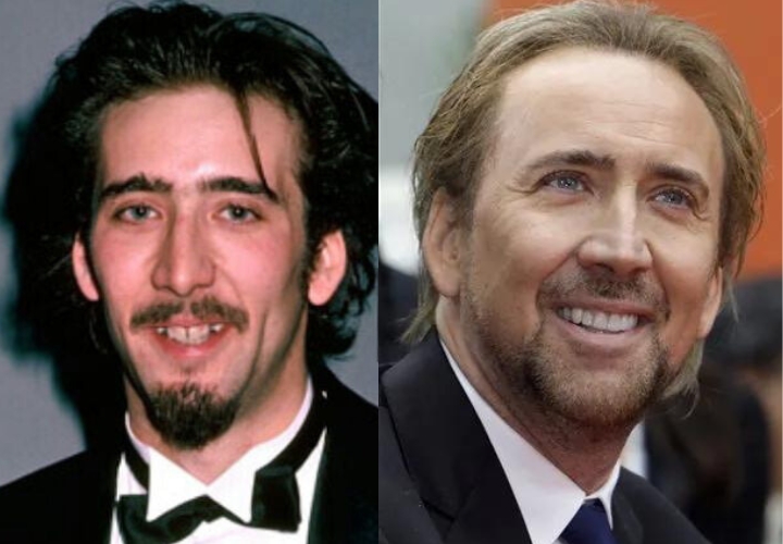 Nicolas Cage celebrity veneers before and after Antalya, Turkey