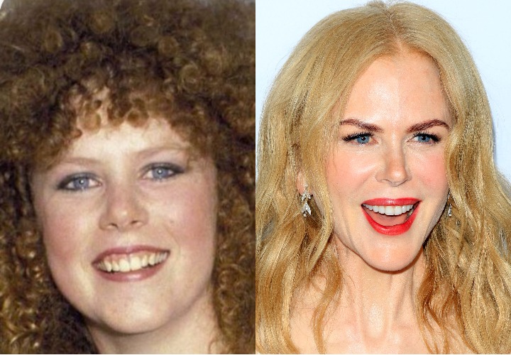 Nicole Kidman celebrity veneers before and after Antalya, Turkey