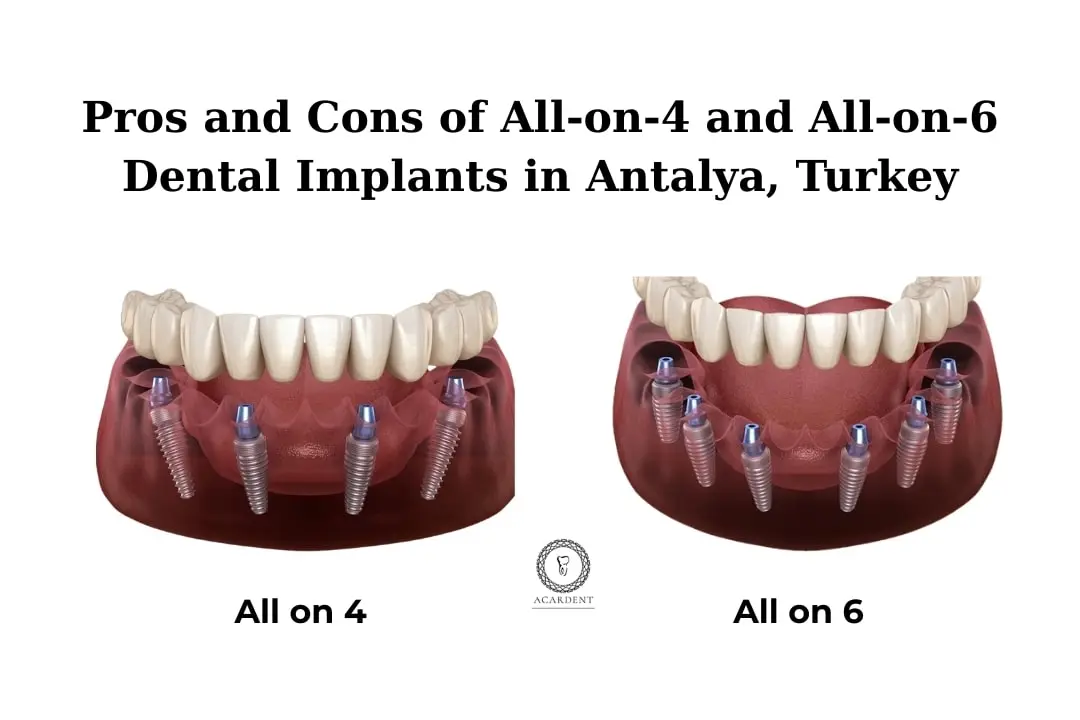 Pros and Cons of All-on-4 and All-on-6 Dental Implants in Antalya, Turkey