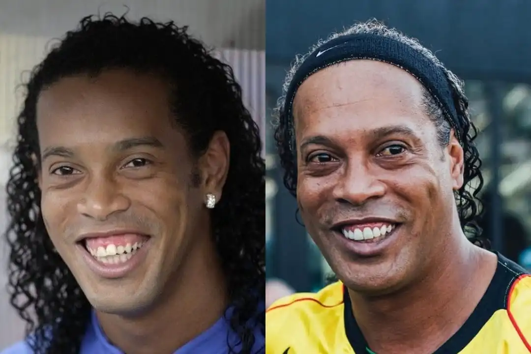 Ronaldinho teeth before and after