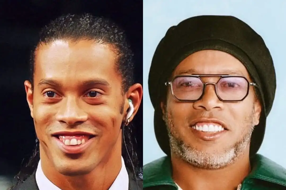 Ronaldinho teeth before and after