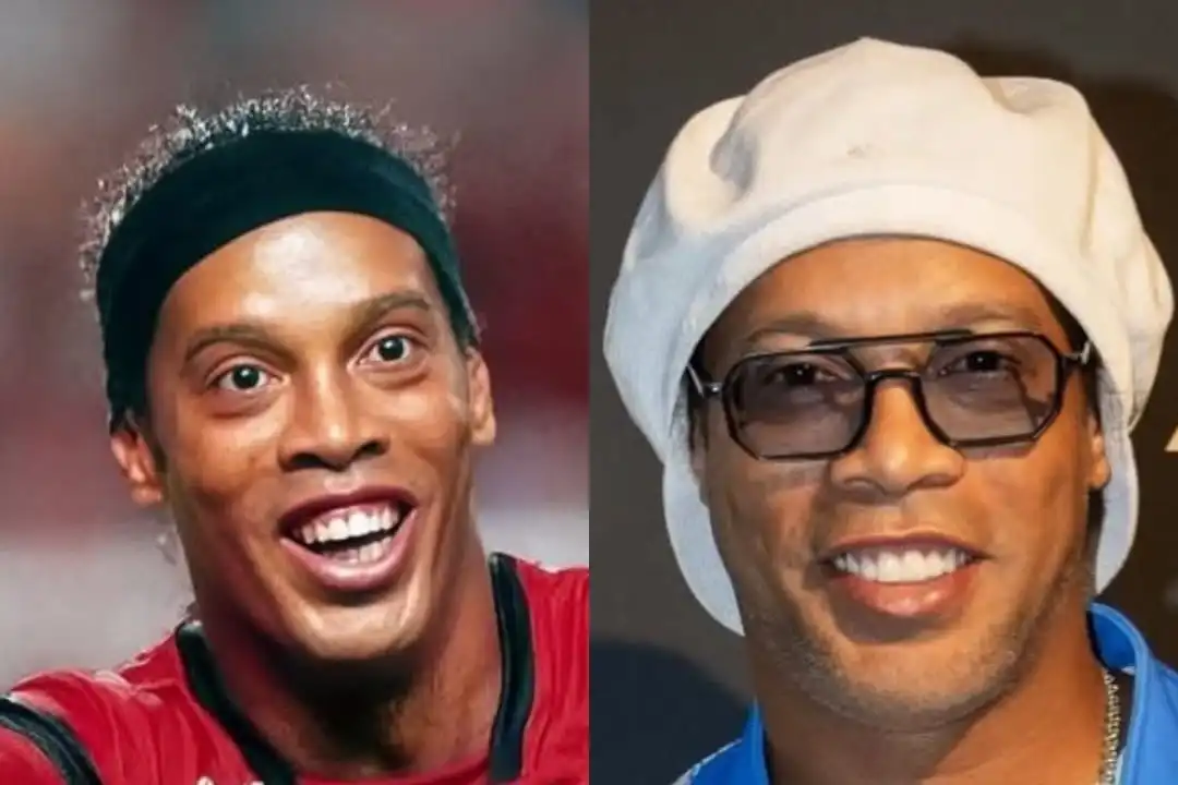 Ronaldinho teeth before and after