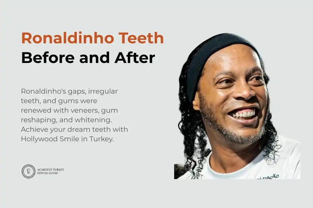 Ronaldinho teeth before and after