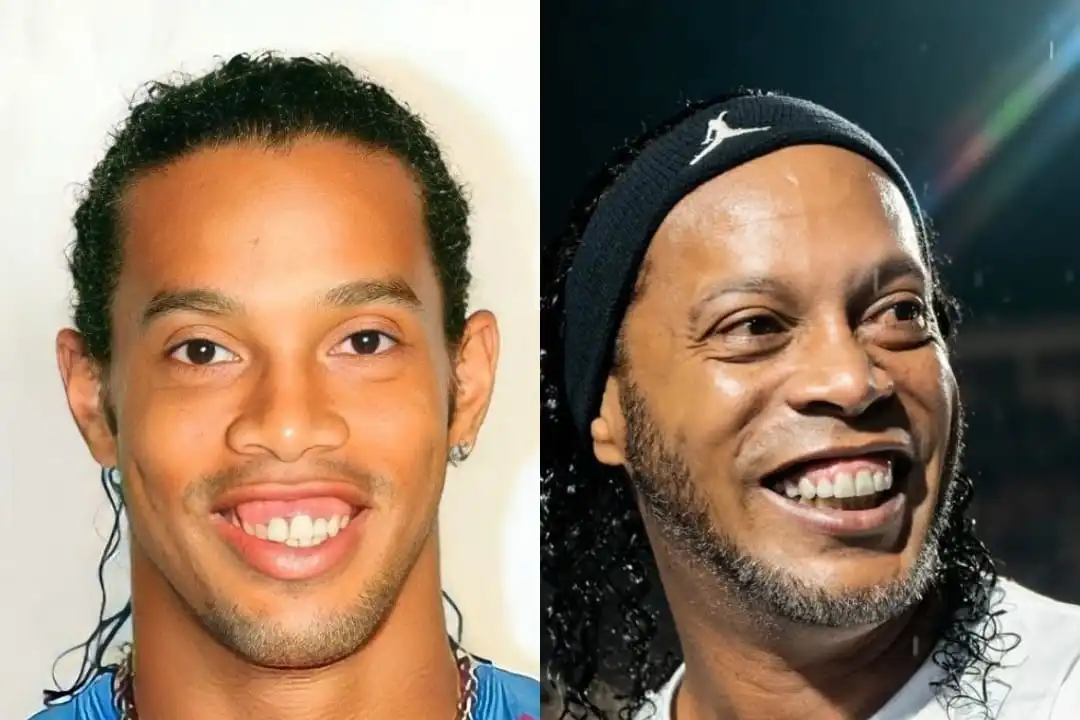 Ronaldinho teeth